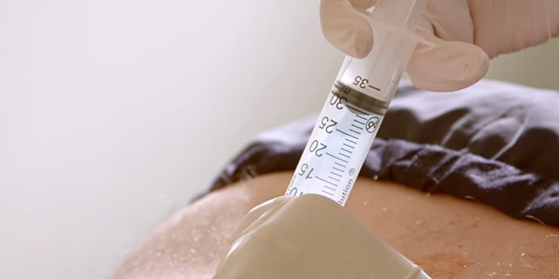 iniezione di ozonoterapia nella schiena