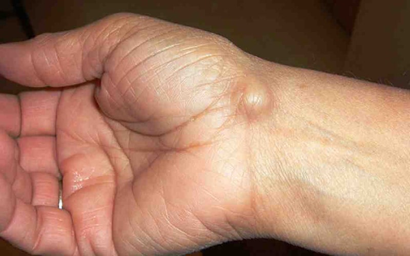 mano sulla ciste